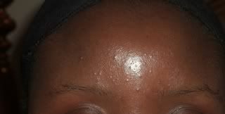 obagiday7forehead-9235802